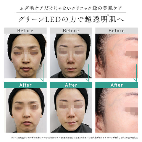 2024年Newモデル》STELLA BEAUTE IPL&LED光美容器(ステラ ボーテ)